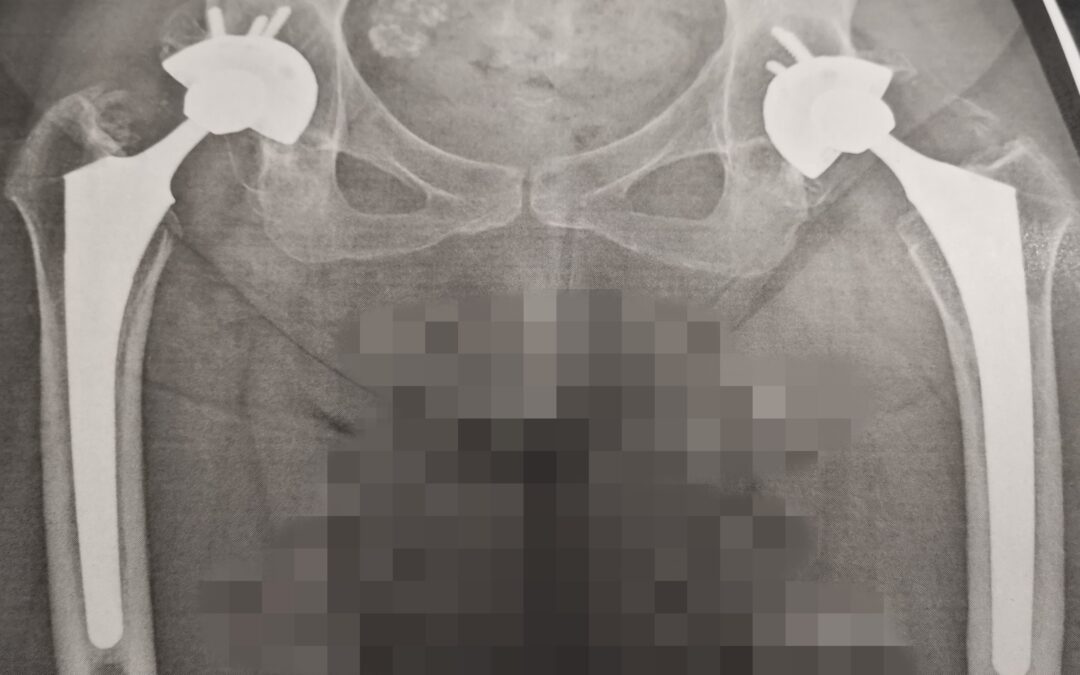 大腿骨骨頭壊死による両側人工股関節置換術(THA)